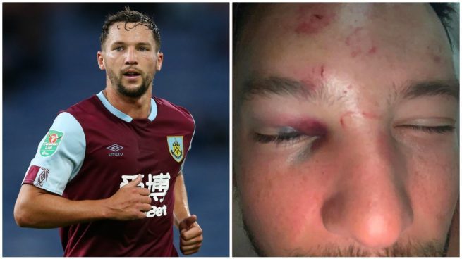 danny-drinkwater-antes-y-despues-de-la-paliza.-655x368